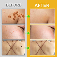 Thumbnail for Bee Venom Moles and Warts Removal Cream