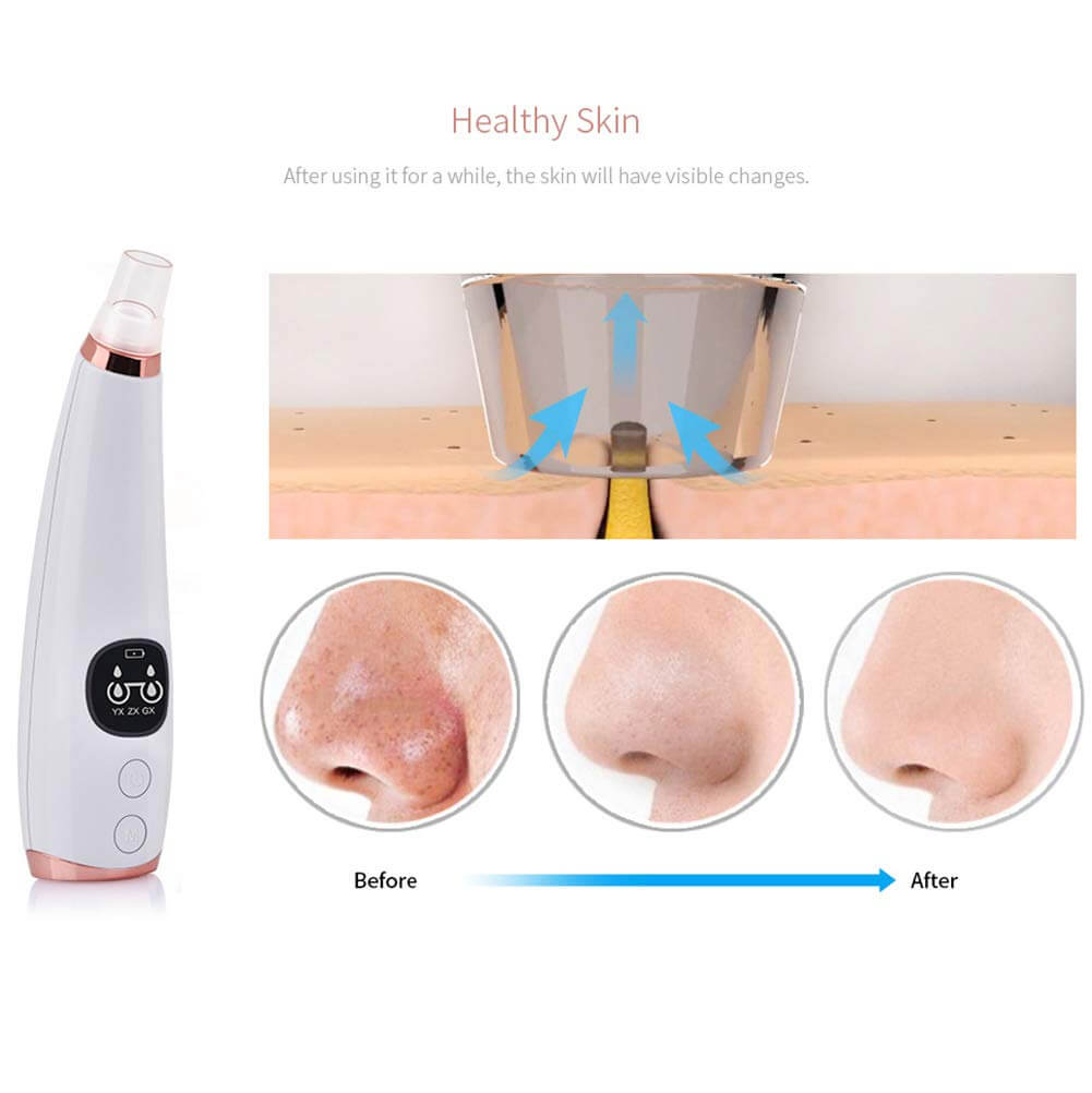 Acne Cleansing Blackhead Remover